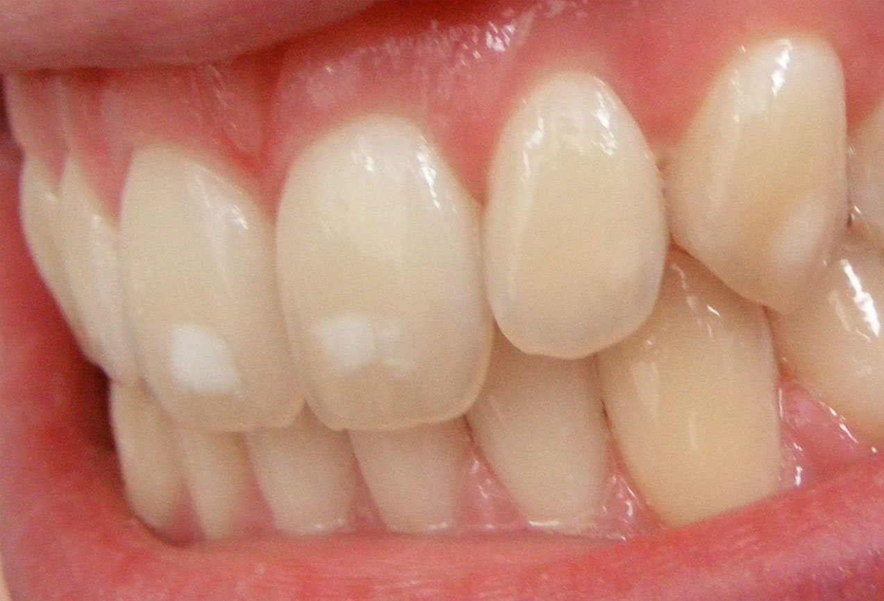 Fluoroosi johtuu liiallisesta fluorin saannista hampaan kehitysvaiheen aikana ja ilmenee valkoisina värimuutoksina.
